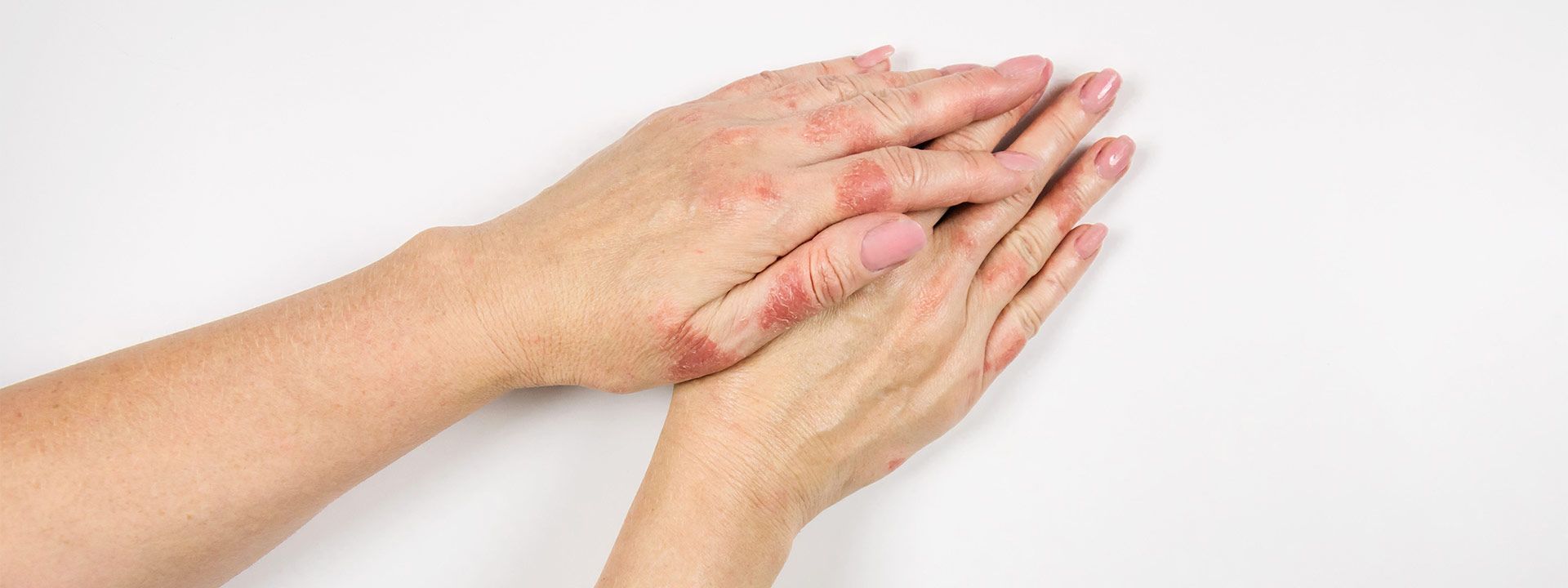 Egzama (Atopik Dermatit) Tedavisi