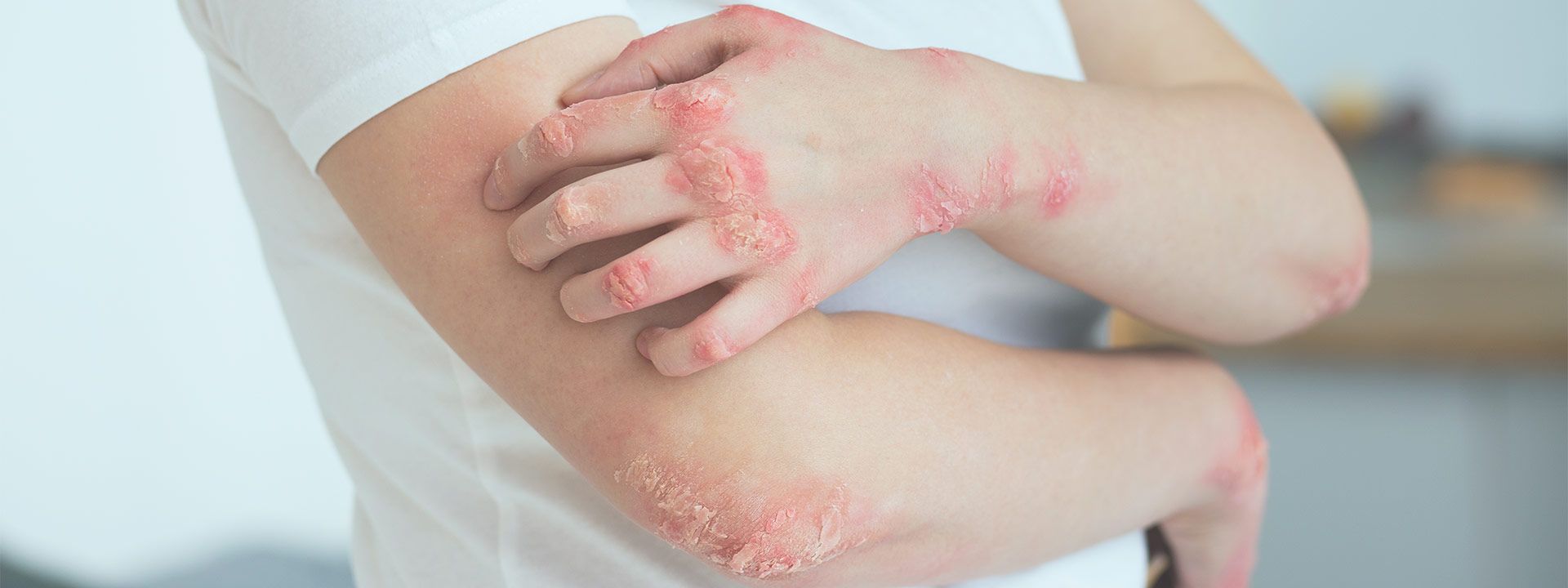 Sedef Hastalığı Tedavisi