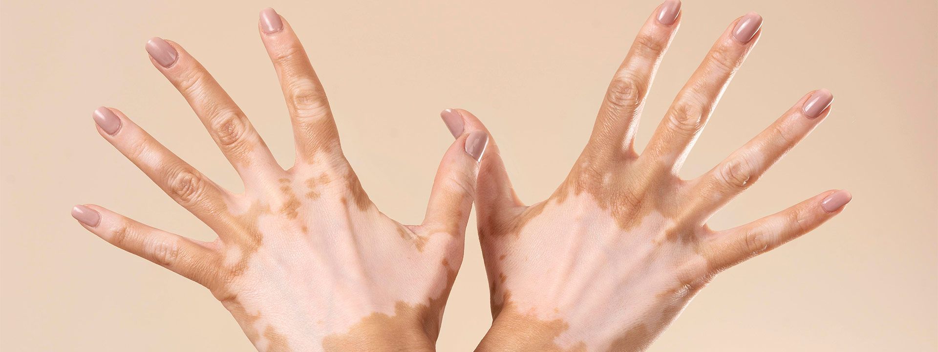 Vitiligo Tedavisi
